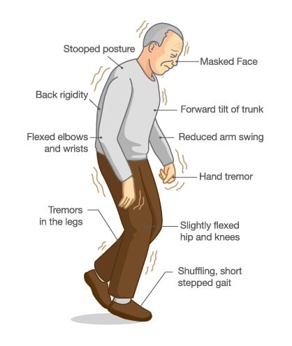 ayurvedic treatment for Parkinson's diseases