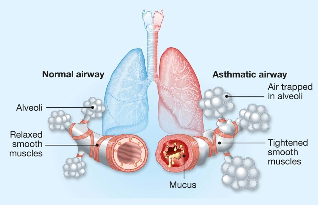 Ayurvedic Treatment for Asthma