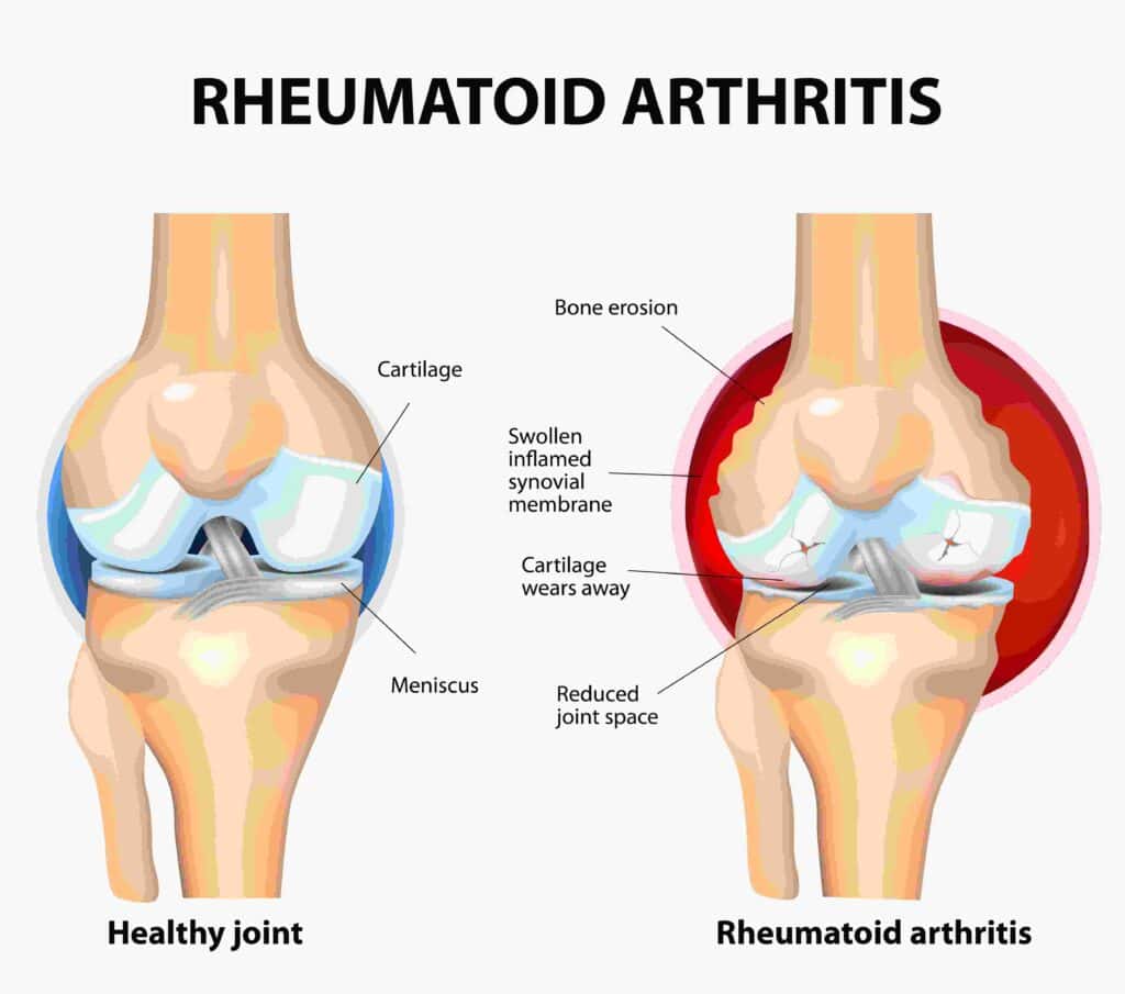 Ayurveda treatment for arthritis