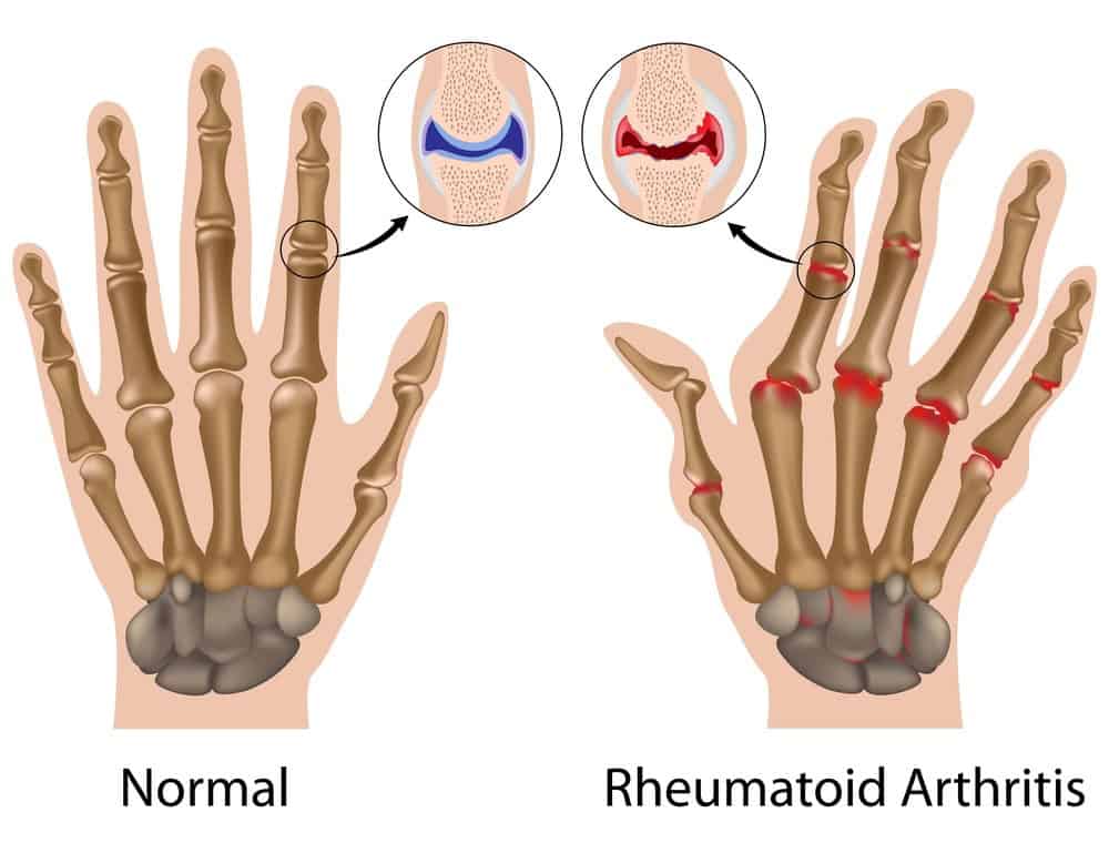 ayurvedic treatment for arthritis